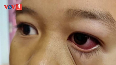 Kon Tum: Bệnh đau mắt đỏ lây lan trong trường học